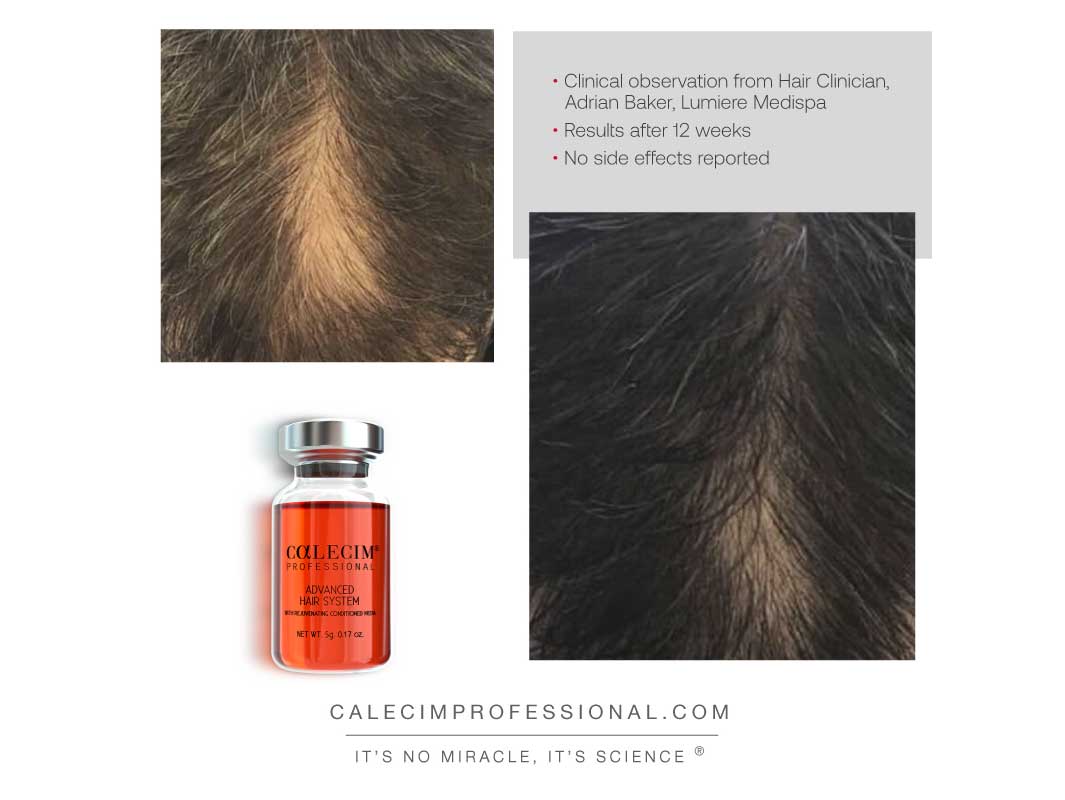 Calecim Professional Advanced Hair System 6 Weeks Kit