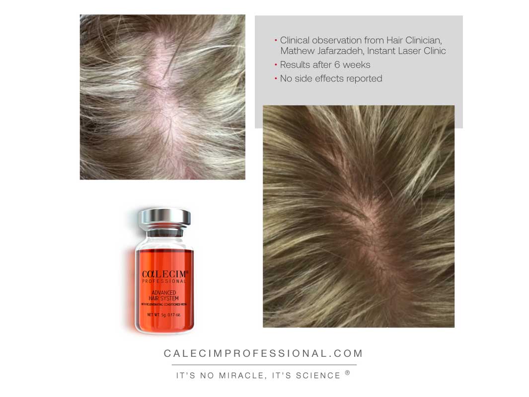 Calecim Professional Advanced Hair System 6 Weeks Kit