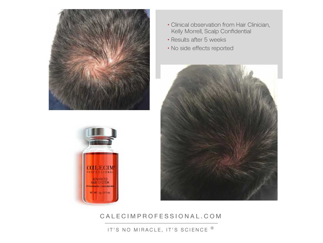 Calecim Professional Advanced Hair System 6 Weeks Kit